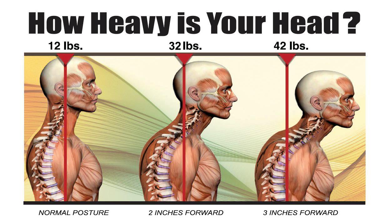 Neck Pain Bad Posture Treatment