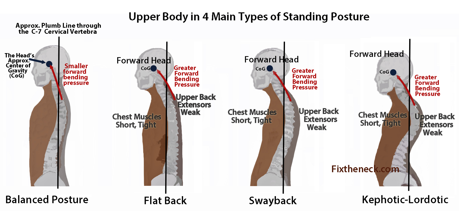 Poor Posture Treatment Snyder Chiropractic Wellness   Posture Treatment 