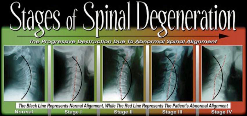 Image result for 4 phases Cervical Degenerative Disc Disease