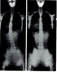 x-ray full spine before and after