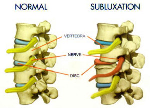 vertebral subluxation treatment