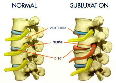 vertebral-subluxation.jpg